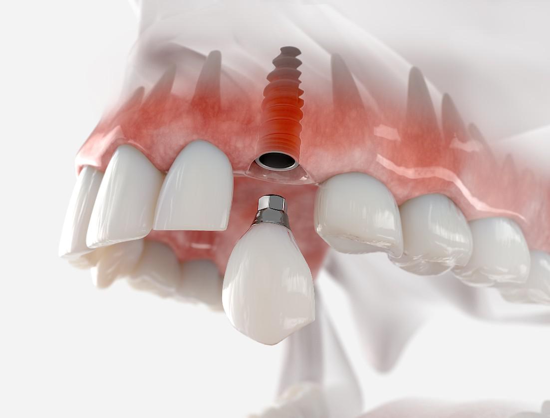Implants vs. Dentures : Which is Right for You?