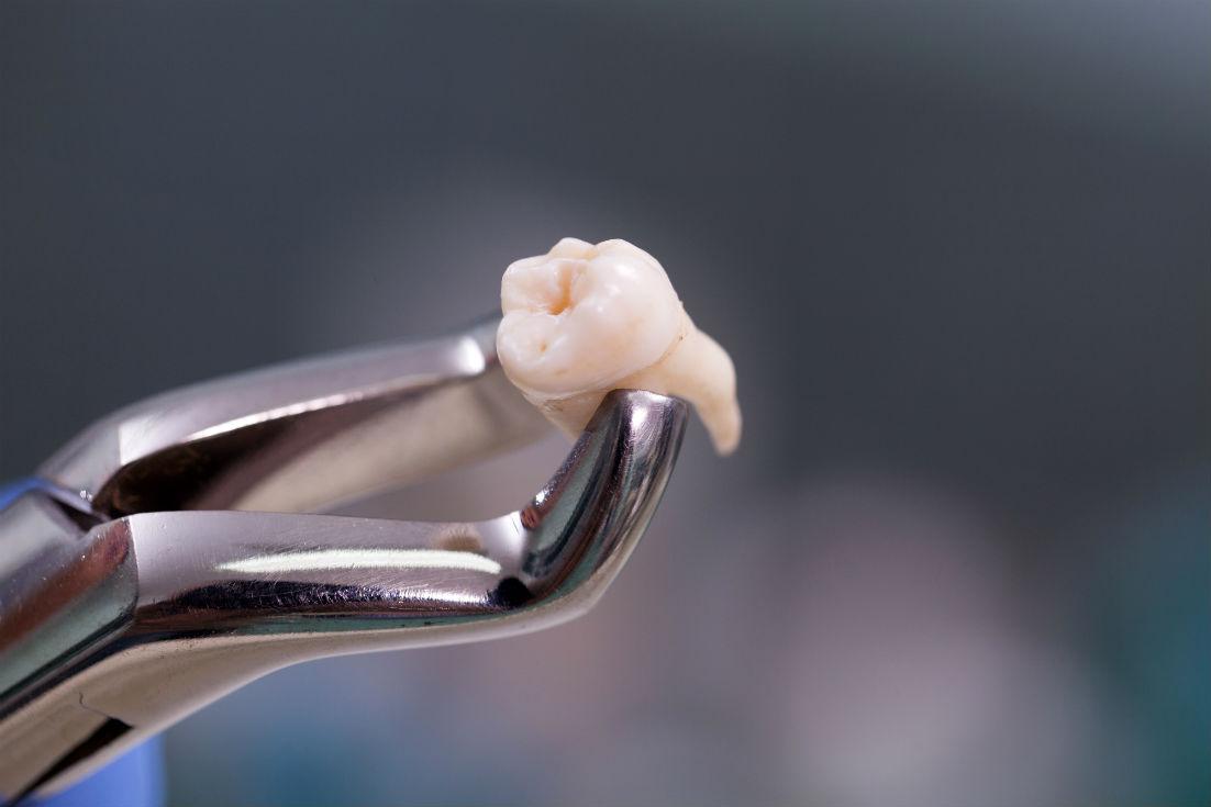 Wisdom Teeth Removal Crystal, MN